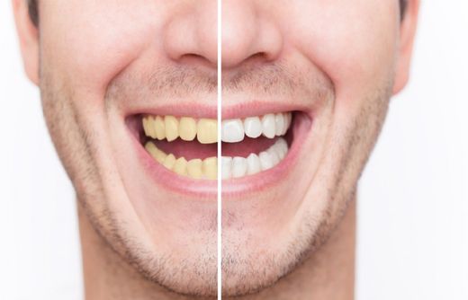 Bleaching - vorher und nachher